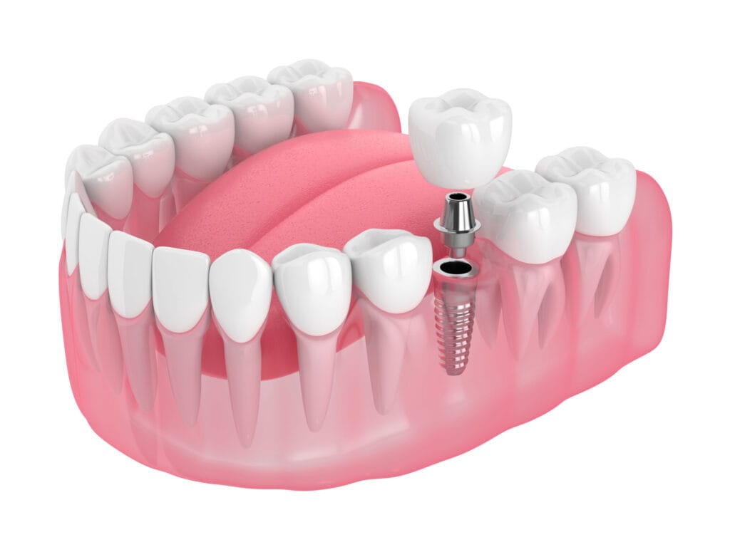 3d render čeľuste so zubným implantátom izolovaných na bielom pozadí